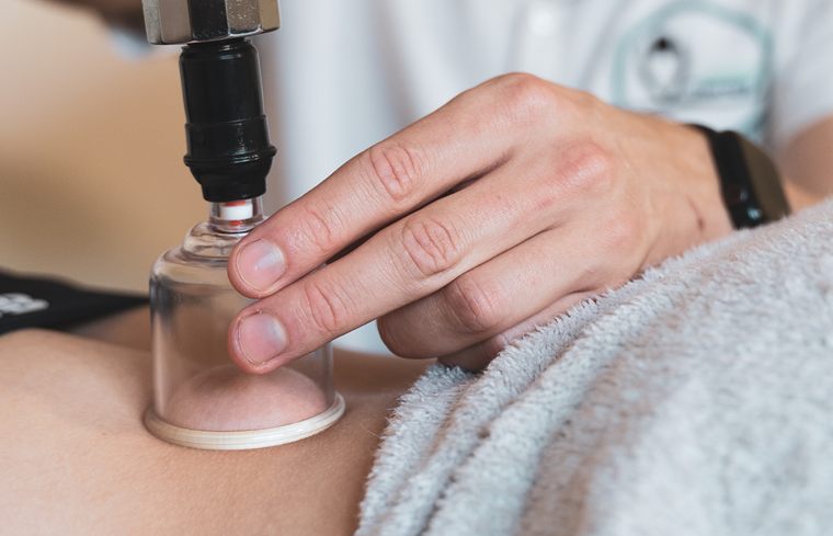 A therapist applying cupping therapy
